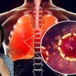 کراچی میں انفلوئنزا کے کیسز میں 20 فیصد اضافہ، کورونا بھی برقرار