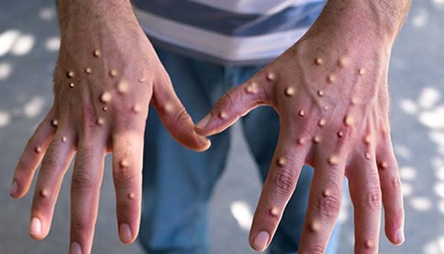 کراچی میں ایم پاکس کا ایک اور کیس، سندھ میں تعداد 42 ہوگئی